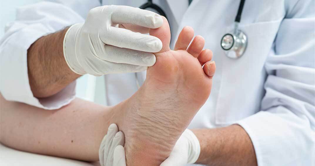 Comment traiter efficacement les mycoses des pieds ?