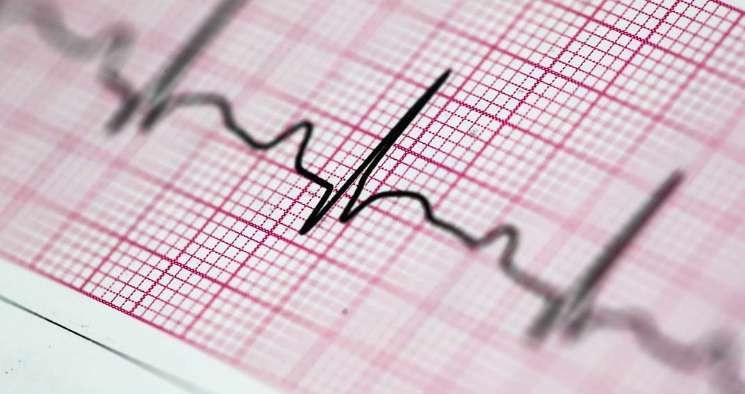 L’amylose cardiaque : une urgence diagnostique
